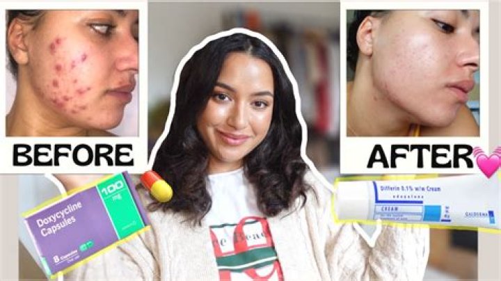 Doxycycline for acne Doxycycline for acne