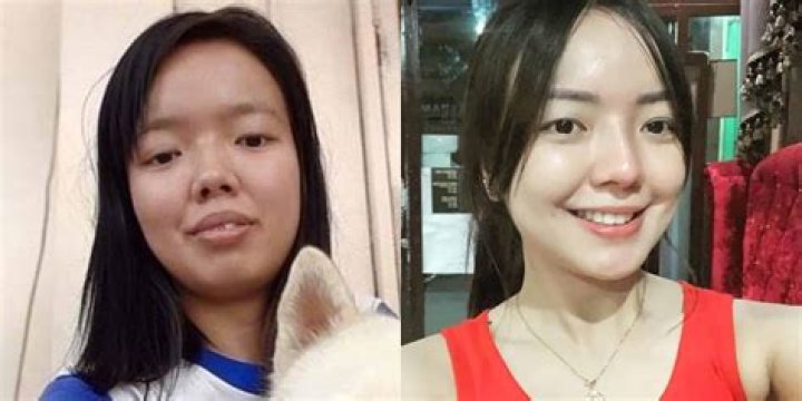 Rosmar Tan before and after plastic surgery